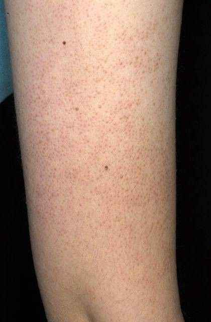 وداعاً للملمس الخشن! ثنائي "ذا أورديناري" للتونر و"يوسرين" للمرطب هو الحل النهائي للتخلص من جلد الوزة والحصول على بشرة ناعمة كالحرير الشريقات, صلاح الدين


**إذا كنت صاحب هذا الإعلان وتريد حذفه لأي سبب، رجاءا أرسل رسالة إلى الدعم الفني**