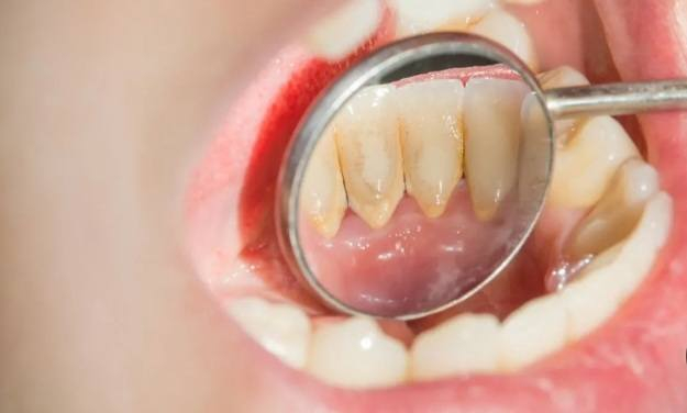 السلام عليكم ورحمة الله وبركاته
الي عنده مثل هاي التكلسات والجذور المتبقية ويحتاج تنظيف او قلع يتواصل ويانه ع هذا الرقم *********** العلاج مجاني بإشراف اطباء اختصاص وننطيكم كروتكم العنوان بغداد باب معظم
