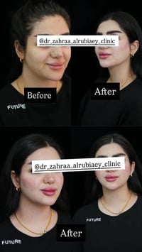 رسمات الوجه والشفه بعيادتنا 💗💗  عروض الصيف نزلت على ابر النضاره والفلر...