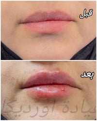عروض عيد الأضحى • فلر بوتوكس • بعقوبة العزات