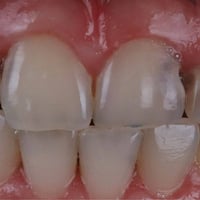 اخواني الي محتاج حشوات باسنانه الامامية بسبب كسر او تسوسات مثل الي بال...