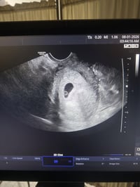 عقم أولي • حمل ٦ أسابيع • كركوك حي الحجاج