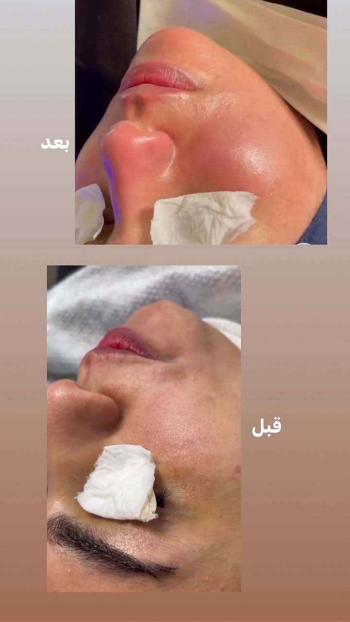 العرووووض بلصور اقوى عرض نزلته شنو منتضرين متحجزون لاتحصرون نفسكم اخر 3ايام حبابين 🫠♥️❌♥️

بوست المسابقه

🥰☘️🌸🎁وعدتكم بليل تنزل وهاي نزلتها

أفوز بااكثر انسانه توصلها مدح بعد الجلسه مالتي انزلو وشاهدو الرسايل وربي يشهد عليه كل الرسايل حقيقيه من زبائني جلسه التنضيف يمي غير غير والي مجربين اكتبو تجربتكم 

هلمره حبيت افرح وحده منكم بلعيد راح اعلن عن الفائز 
شروط المسابقه. اكثر تعليق ومشاركه وتآكات وتعليق الي مجرب يذكر تجربته ظروري واهم شي المشاركات بلكروبات وراح أفوز وحده بيكم🌝👩‍❤️‍👩@إشارة

بنات لتنويه من ترفعون المنشور بتعليقاتكم الي تريد تربح بلمسابقه ترد على تعليقها وتصعد يعني التعليق خلي بلرد


**إذا كنت صاحب هذا الإعلان وتريد حذفه لأي سبب، رجاءا أرسل رسالة إلى الدعم الفني**