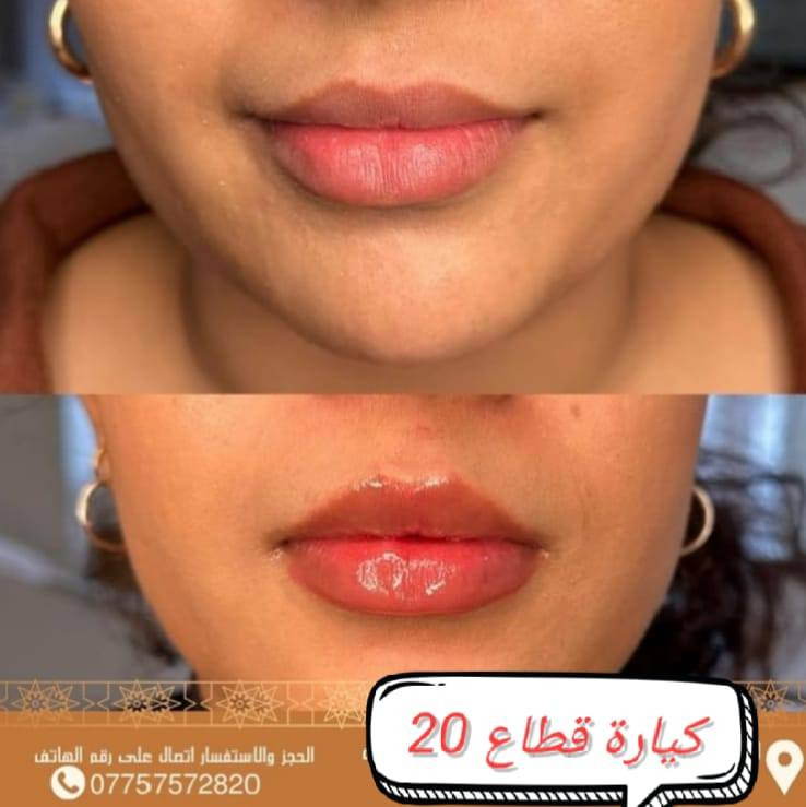 عروض عيد الفطر المبارك  🌙من مركزشهلا بيوتي للتجميل 🌙

مكياج 20الف فقط تسريحة 20الف🌙 حنه + عرس مع جميع الإضافات 150😍

بكج 50 الف 
صبغ +تخصيل+ قص+معالج + سشوار للشعر القصير والمتوسط 

بكج 25
حف +تنظيف بشرة عميق +بدي كير

رموش كامله  20الف
طرفيه 15الف
حفافه +شمع 15الف فقط
حفافه 10 الف
تنظيف بشرة بجهاز الهايدروفيشل 25 الف
تنظيف بشره بالهايدرو مع اوكسجينو 35 الف

بدكير ملكي  10الف فقط
جلش قدم او يد ١٠ الف 
جل اكستيشن بناء فقط 15الف
جل اكستيشن مع جلش ودزاين  30 الف
لـكل جـمآل عـنـوآن ونـحـن صـنآع آلـجـمال🧷✂❤️

 العرض الاول :::💄

سحب لون + صبغ شعر قصير+قص ومعالج =40 الف  ❤
سحب لون +صبغ شعر متوسط+قص ومعالج =60 الف ❤
سحب لون + صبغ شعر طويل+قص ومعالج =100الف❤

العرض الثاني:::💄

صبغ شعر + تخصيل + قص ومععالج للشعر القصير =30الف❤
صبغ شعر + تخصيل + قص ومعالج للشعر المتوسط = 40الف
صبغ شعر + تخصيل+ معالج وقص  للشعر الطويل 75 الف❤

العرض الثالث :::💄

عروض التخصيل بالسيلفون💚❤💚❤

صبغ +تخصيل + قص & معالج  شعر قصير =50الف ❤

صبغ +تخصيل +قص &معالج  شعر متوسط =60 الف
❤
صبغ تخصيل +قص + شسوار+معالج  شعر طويل =100الف 💚

 *قص & شسوار & تريتمنت =15 الف بس ❤

عروض المعالج والمسرح ❤💛❤

العرض الرابع :::💄
معالج + مسرح للشعر القصير = 50 الف 💚
معالج + مسرح للشعر المتوسط = 75 الف ❤
معالج + مسرح للشعر الطويل يحدد السعر بعد المعاينه 💚
يغسل نفس اليوم 

#عروض التاتو ❤

تاتو 6D سعر الجلسة =35❤
تاتو فايبرز سعر الجلسة =35❤
تاتو بلوك سعر الجلسة =20الف ❤
تاتو مايكرو سعر الجلسة =35 الف❤

توريد الشفه الجلسة الواحدة = 20💚💜💚 
💗تحديد  الشفه  سعر الجلسة الواحدة =20 الف ❤💚

عروض الوشم 🖋🦋
يبدأ سعر الوشمة من 15 الف الى 25 حسب حجم الوشمة 🦋

 
كوكيز 40خصله 250 فقط😍

 القسم الطبي 
 
🍃التغيير الشامل فلر  200 الف

🍃فلر كوري سعر السيسي الواحد 30 الف 
🍃فلر ايبتك 50 الف السيسي  الواحد 
🍃ابرة العنبر 50 الف 
🍃بوتكس رفع حاجب وجبين 75 الف 
🍃ابرة السلمون الغنيه عن التعريف 100الف

📍العنوان: مدينة الصدر / كيارة قطاع20 مقابيل حيدر نت/ صالون شهلا بيوتي 

☎️ للاستفسار والحجز الاتصال على الرقم التالي:***********
