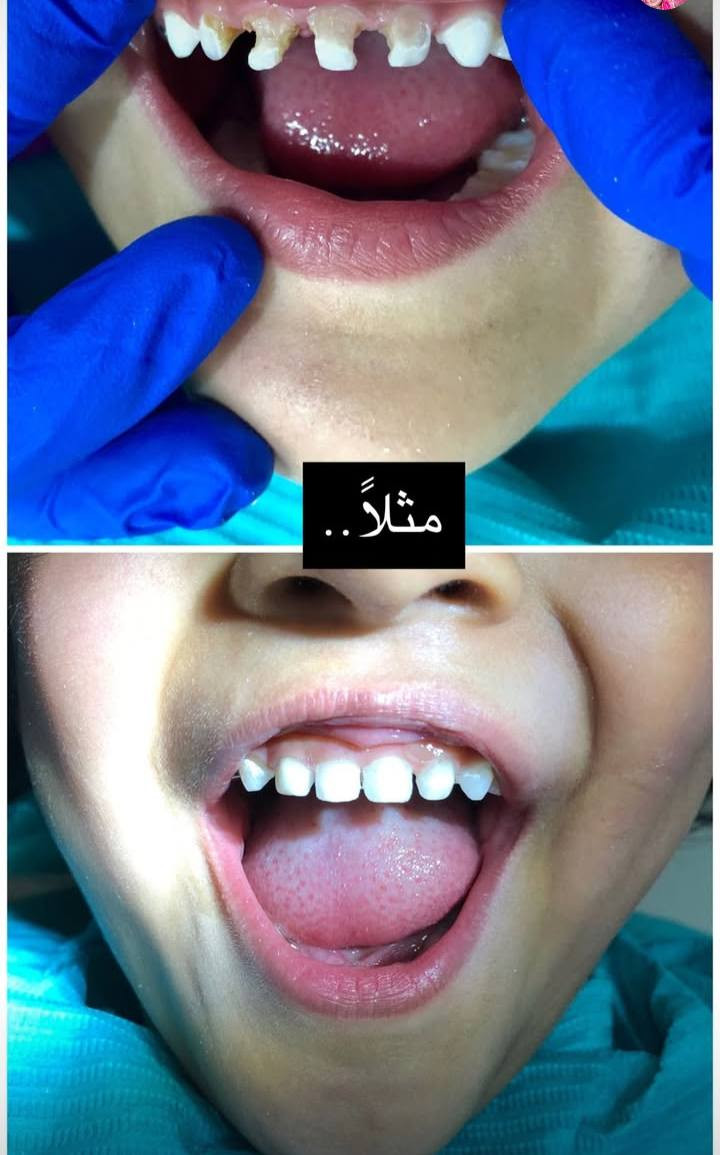 السلام عليكم 
اللي يحتاج علاج يخص أسنان الأطفال
(فحص، تنظيف، حشوات، قلع أسنان لبنية، تطبيق مادة الفلورايد للحماية من التسوس ، علاج آلام الأسنان، والمتابعة الدورية)
يتواصل وياية حتى أحجز له موعد
📍 في المستشفى التعليمي – جامعة الكوفة
📩 للتواصل عبر حساب الفيسبوك
📱 أو واتس آب: ***********
