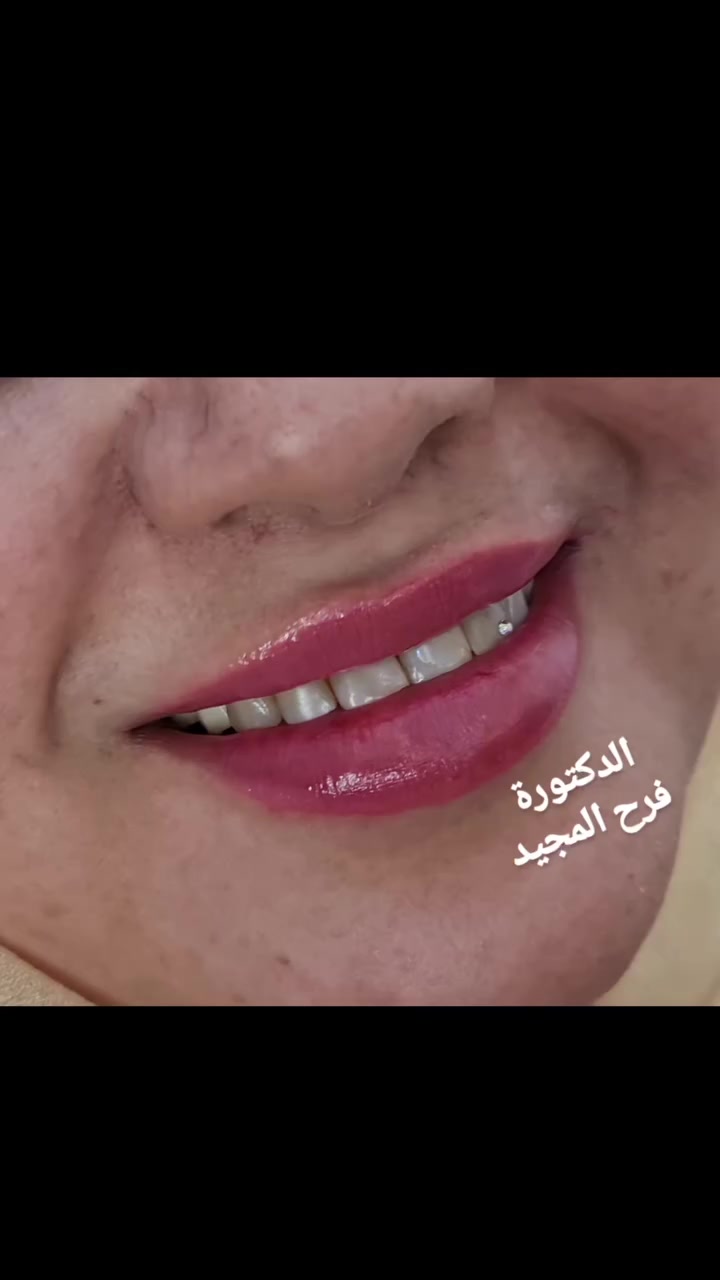 #جمال شغلي #نظافة شغلي#جمال النتائج #وفرحة مراجعتنا الدائمه بالنتيجة الفورية لفلر الشفه #بأرقىىىىىى الماركات العالمية #بيد الدكتورة فرح مجيد #اختصااااااااص في تجميل الاسنان #خبرة ١٤ سنه بالعمل المستمر 😊😊😊😊😊😊😊
#انسب الاسعار واعلى جودة وبدون الم🥹
#تردين تغيير حقيقي بنتائج ممتازة جدا بس عليج الحجز بعيادتنا 👋👋
*********** واتساب للحجز المبكر
بعقوبة😉 مدخل شفته الرئيسي
تابعوني صفحة الفيس بأسم الدكتورة فرح المجيد 
الانستكرااااااام للمتابعه
https://www.instagram.com/dr.farahalmajeed?igsh=MTBxODRuZ2s1MHp4MA==
