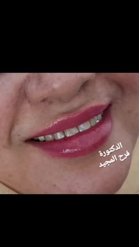 تجميل اسنان • فيلر شفه • بعقوبة