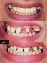 تركيب أسنان زيركون • مجمع اليمامة • ٢٢ سنة خبرة