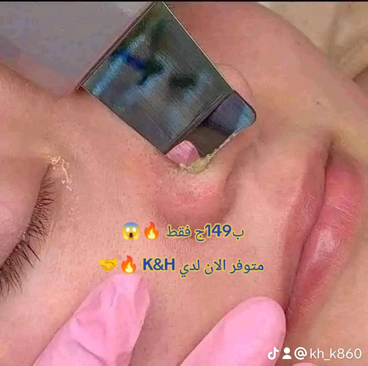 ب149ج فقط 🔥 😱 الترا سونيك عرض عليه اول مره بنزل بالسعر ده
🐆جهاز الالترا سونك لتقشير طبقه البشرة الخارجية ومعالجه البشرة وازاله الجلد الميت والرووس السودا والبيضا واثر الحبوب والدهون  من البشرة الجهاز بيستخدمو في عيادات 💙

جهاز الترا سونيك الاسكرابر المقشر لبشرتك 😍💃💃💃 بالموجات فوق

 الصوتيه

يعني تقنية التخلص من الخلايا والنفايات الميتة بالموجات فوق الصوتية 💕💕⁦❤️⁩ 

ومنع وتقليل التجاعيد وإزالة حب الشباب وقبض  المسام😍😎 

وكمان تجديد وإحياء الجلد 🤩🤩🌸⁦❣️⁩⁦❤️⁩ 

احلي جهاز مناسب لجميع أنواع البشرة ، حتى البشرة الحساسة 💃💕💃

بصي انتي من الاخر مش هيبقي ف وشك اي مشاكل بعد ما تستخدميه و هتشوفي من اول مره 💙💙🥰
#صلي_علي_النبي✨ 
متوفر الان✨ 👈 #K &H 🥰 😍🙈💙
‏‎🟥تابعنا طول اليوم كله جديييد في جدييد 🎇🎇🎇🎇
‏‎⚡️⚡️⚡️⚡️اسعار خاصة  ⚡️⚡️⚡️⚡️⚡️⚡️
‏‎🟧مواعيد العمل كل يوم من الساعه 7ص حتي ١٠م 
‏‎🟥للتواصل وعمل الاوردرات /   01202368197
‏‎🟧العنوان / الإسكندرية عبد القادر المجزر قبلي السكه الحديد شارع قهوة عبدة الجزار بجوار مكتبة القدس أو  احمد انكش للمقاولات او اخر شارع مدرسه ام سلمة
❤️تابعوا علي تيك توك 
https://www.tiktok.com/@kh_k860?_r=1&_t=ZS-97BDnwixFM9
‏‎🟥تابعوا واتس اب  علي 
https://chat.whatsapp.com/F8pOGfQziFg3Y2ej7zuUfi?s=sh&p=a&mlu=2
🔥 تابعوا علي التليجرام 
https://t.me/khaledhegazybakr
🔴 تابعوا علي جروب الفيس بوك
https://www.facebook.com/groups/1252540423127129/?ref=share&mibextid=NSMWBT


**إذا كنت صاحب هذا الإعلان وتريد حذفه لأي سبب، رجاءا أرسل رسالة إلى الدعم الفني**