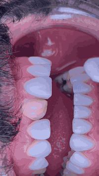 ✨ ابتسامتك هي هويتك… خلّيها تلمع ✨
في عيادات الدكتورة إيلاف محسن التخصصية لطب وتجميل الأسنان
نحن لا نغيّر الأسنان، نحن نصمّم تحفًا فنية 🌿

تحلم بابتسامة متناسقة، بيضاء، وطبيعية؟
قشور E-max هي الحل الأمثل لعلاج:
✅ الفراغات بين الأسنان
✅ التصبغات الدائمة
✅ عدم التناسق في الحجم والشكل

خلال جلسات قليلة فقط، نمنحك الابتسامة اللي لطالما حلمت بيها 😍

📥 اكتب كلمة «ابتسامة» بالتعليقات ونرسل لك كل التفاصيل

📞 للحجز والاستفسار (واتساب): #***********
📍 العنوان: المدائن – شارع الأطباء – مقابل صيدلية أبو أثير المشهداني

#ابتسامة #Emax #تجميل_الأسنان #SmileDesign
#عيادات_الدكتورة_إيلاف_محسن #عيادة_أسنان_بغداد
