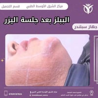 جلسة ليزر • ببلز بعد ليزر • الشطرة ذي قار