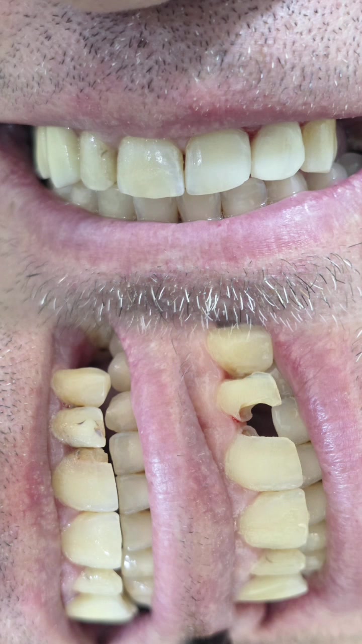 إعلان طبي | عيادة الأسنان
🦷 تتوفر في عيادة طبيب الأسنان علي فواز النعيمي في الموصل أحدث الخدمات العلاجية والتجميلية للأسنان، مع اهتمام دقيق براحة المريض وجودة العلاج.
📍 الموقع:
الموصل – حي البكر – مجمع الرؤوف الطبي – مجاور رفعت ماركت
📞 للحجز والاستفسار واتساب:
***********
🦷 الخدمات المتوفرة:
علاج وتسوس الأسنان (حشوات تجميلية وعادية)
خلع الأسنان البسيط والجراحي
علاج عصب الأسنان (سحب عصب)
تنظيف وتلميع الأسنان
تبييض الأسنان
تركيب جسور وأسنان صناعية
علاج التهابات وأمراض اللثة
✨ ابتسامتك تبدأ من هنا… لا تهمل صحة أسنانك
📌 عيادة طبيب الأسنان علي فواز النعيمي – خدمات متكاملة في مكان واحد داخل مجمع الرؤوف الطبي
