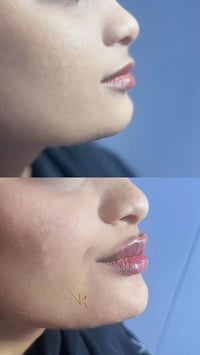 عرض فلر شفة+تحديد فك  150 الف د  07805206149للحجز و الاستفسار