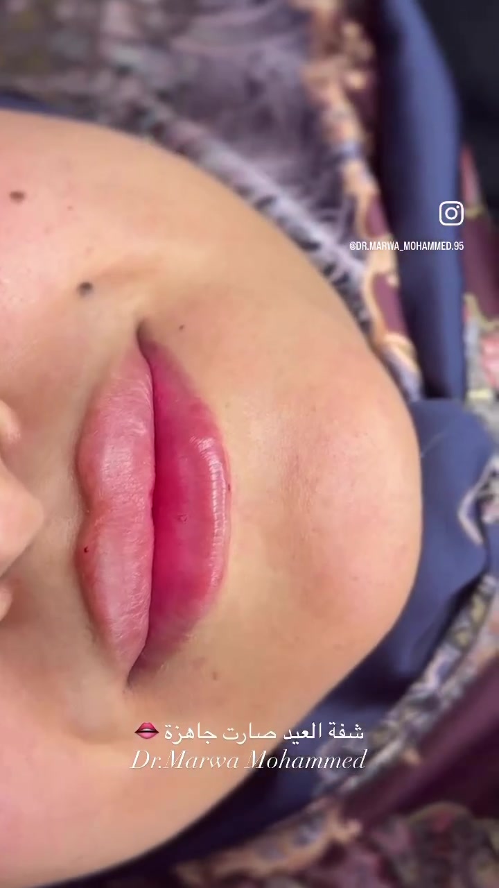 إذا تحبون شفتكم تبقى طرية ومرسومة بحجم طبيعي اختاروا تيوسيال السويسري ✨👄 ترافته 
واضحة

العروبة شارع المتحف مجاور مطعم كودوكودو 🏥


**إذا كنت صاحب هذا الإعلان وتريد حذفه لأي سبب، رجاءا أرسل رسالة إلى الدعم الفني**