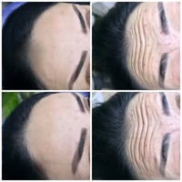 بوتكس فرنسي • نتيجة البوتكس • توله فروش