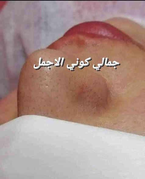 عروض كرسمس ،🎆🎀🎆
حفافة فقط 8

تنظيف بشرة 10بجهاز الهايدوفشل 

حفافة مع تنظيف بشرة بجهاز الهايدوفشل 15

المجموع قبل العرض 28

العرض صار المجموع 15
 

دللي نفسج وبسعر 15فقط 
حفافة مع تنظيف بشرة  كل هذا بسعر 15
صبغ الشعر القصير جداٍ بسعر 15 
الوسط 15
الطويل 25 

صبغ وميش للشعر القصير 35
فقط ميش 25
صبغ وميش للشعر الوسط 50
فقط ميش 35
صبغ وميش للشعر الطويل 65
فقط ميش 50

دكتورة رصابرين خبيره تجميل
عرض اول مره يصير حصري يمنا 
 
فلر كوري براند السعر السابق 150
السعر حالين سيسي واحد ب50
عرض يجنن ستغلو العرض ميتكرر

العرض ينتهي يوم 1/1

العنوان.  كربلاء قنطرة السلام
صالون الروان

💜أهلا وسهلا  ) 

الحجز وتساب ***********
H .M c🪻🪻🪻🪻🪻🪻🪻🪻🪻🪻🪻🪻🪻#عيادات_تجميل #اطباء #مراكز_تجميل #مخدر_موضعي #فلر #ميزوات #بلازما_البشرة #طبيبات_جلدية  #بغداد_العراق #صالونات #ميزو #فلر #ميزو_فلر #مراكزتجميل #عيادات_تجميل #اطباء #صالونات #بغداد_العراق #مستحضرات_تجميلية#بوتوكس #ميزو #بشره #جلد #جمال #فلرات #شفاه
@إشارة
