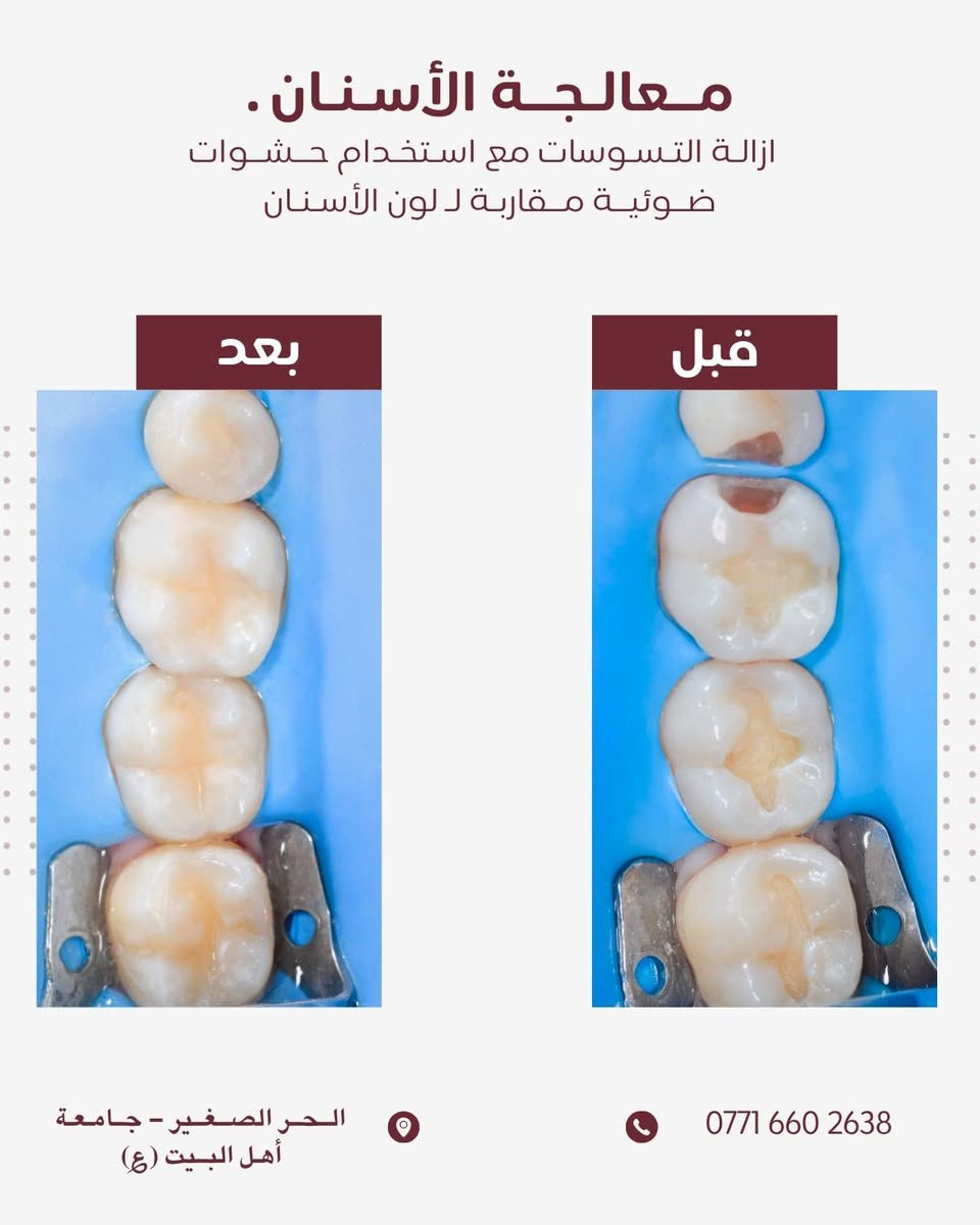 مـجـانـاً 
عمل خيري موافقة الادمن المحترم 
السلام عليكم 

الأسنان بصورة عامة حالها حال اي عضو بجسمك ضروري تعتني بيهم و ترتبهم، الاهمال ب مرور الوقت يكلفك جهد و قيمة مادية 💲 .
واني ب صفتي طالب متدرب ممكن اساعدك نخلص من كل مشاكلك تحت أشراف افضل الكوادر الطبية .
● جميع الحالات المذكورة ادناة مجاناً و جودة عالية ✔️.
● اضافةً علاج جميع حالات الاطفال من ( 6 - 15 ) سنة .
و مشاكل المفصل الفكي او التهابات السان و الثه 

تفاصيل اكثر : اتصال او واتساب 

0771 660 2638 🦷 كربلاء, العراق
