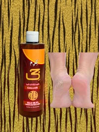 تششقات القدم • كالوس كرم جي • علاج القدم