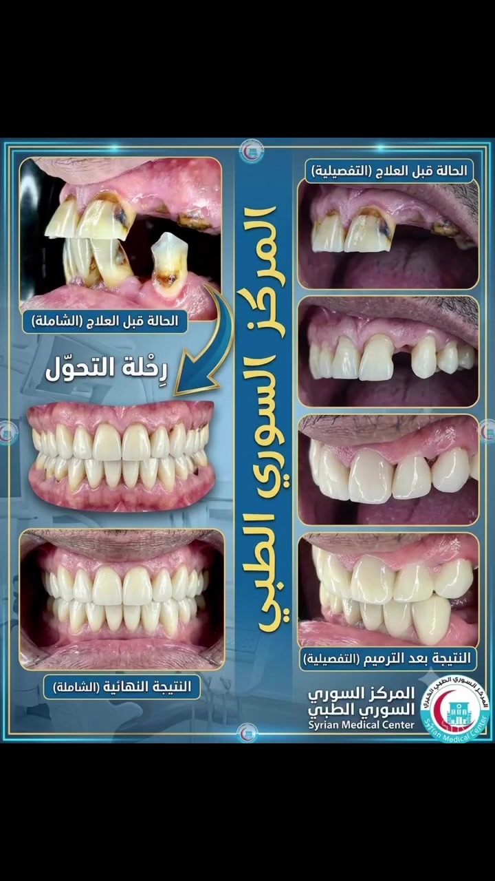ابتسم دائماً ❤️
الشغل الصح ✅ بالمكان الصح✅🫡

(زراعة-تقويم-تغليف-تركيب)

#ملاحظة ضمان مدى الحياةأدواتنا استخدام واحد فقط

المياه المستخدمة أثناء المعالج معقمة(كاسات) 

للحجز والاستفسار مراسلة الصفحة أو الاتصال على الأرقام التالية ☎️*********** _***********

#اسنان #زراعة #تقويم #تغليف
#المحمودية #بغداد #مدينة_الصدر

تيك توك 👇👇👇
￼https://www.tiktok.com/@mstk520?_t=ZS-8vKXPDhbuIm&_r=1

انستا 👇👇👇
https://www.instagram.com/lmrkzlswryltby/
profilecard/?igsh=Y2d5ODJ5Z3YwNWl3
