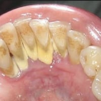 تنظيف اسنان مجاني للاسنان الي مثل الصور في البصرة والزبير للتواصل 0782...