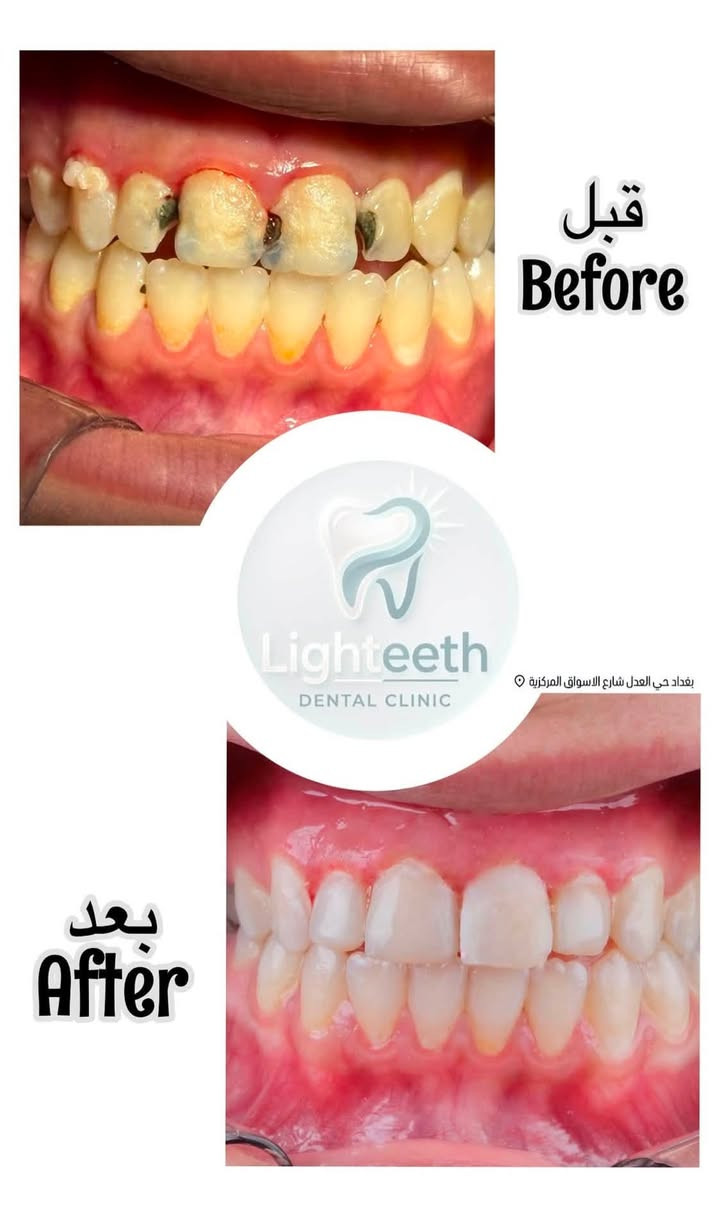 عيادةlighteeth
لدكتور
اسامة احمد الحسني
لزراعة وتقويم وتجميل الاسنان توجد خدمة طوارئ الاسنان
وتتواجد طبيبة 
تجميل أخصائية
فلروبوتوكس ونضارة للوجهه
أوقات الدوام
من الساعة ال ١٠ صباحاٍ حتى الساعة ال ١٠ مساءا
موقع العيادة:
حي العدل
-شارع الأسواق المركزية -
مجاور حاجة الف
لحجز واتساب او التواصل عبر الخاص.
***********

