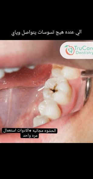 🔴علاج اسنان مجاني وباشراف اطباء اختصاص 
_قلع
_تنظيف اسنان 
_حشوات  ضوئية
_تقويم متحرك
_طقم كامل متحرك
_حشوات اطفال وفلورايد ( ماده تمنع تسوس اسنان الاطفال)
_علاج مشاكل اللثة والتقرحات 
_علاج الام المفصل الصدغي
_اشعة وفحص للاسنان  
📍عيادات جامعة الكوفه خلف كليه الفقه
للحجز والاستفسار: 
@manar_w44 
***********
