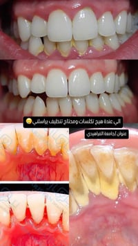 منو محتاج تنظيف اسنان من تكلسات التصبغات  هذا اخر شهر مجاني  عنوان جام...