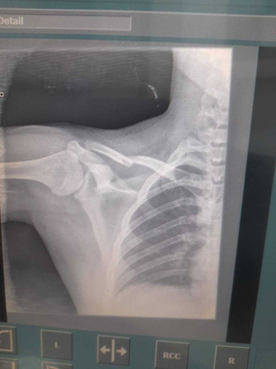 السلام عليكم 
عيادة التقوى للفحص بالاشعه لجميع انواع الكسور والاصابات الرياضيه والمفاصل ولكل اجزاء الجسم الملونه والعاديه 
جهاز CR ,,الحديث 
العنوان الرمادي  ٥كيلو مقابل جامع الشهداء
للاستفسار على الرقم ***********
واتس اب واتصال 
الصحه والسلامه للجميع يارب
