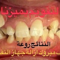 التقويم يميزنا الف مبروك ازالة الجهاز و النتائج روعة من اعقد حالات الت...