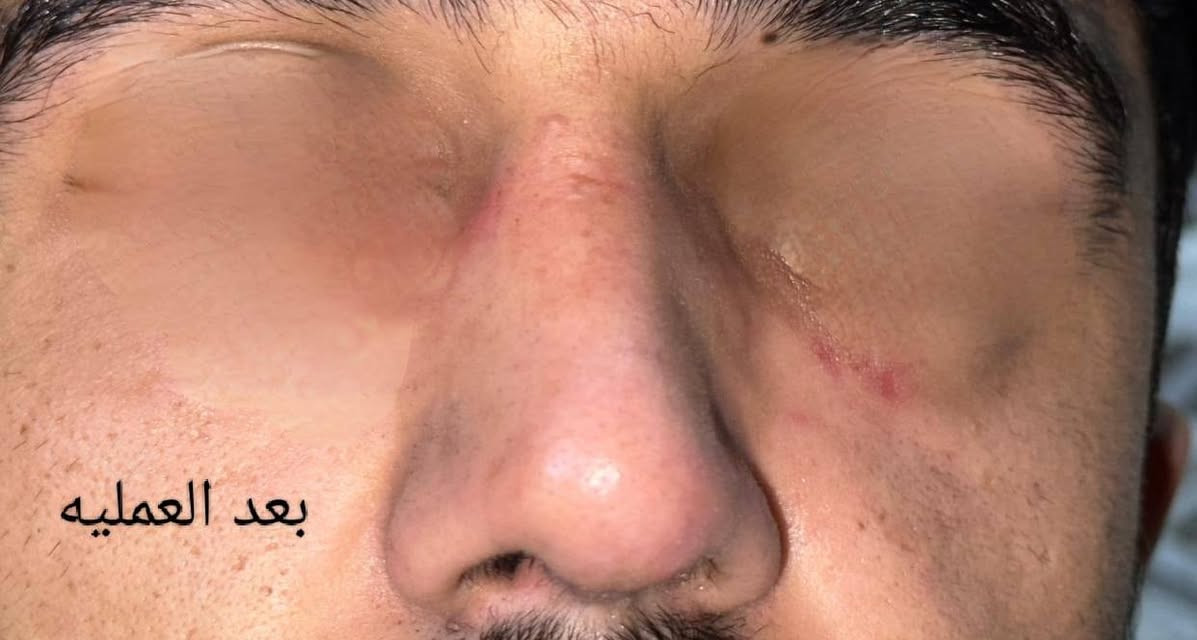 اليوم الجمعة #مساءً باذن الله
متواجد الدكتور #مجيد_يوسف مجيد 
طبيب اختصاصي بورد في جراحة الأنف والأذن والحنجرة
حالات نزلات البرد والاحتقان والرشح
مشاكل الفقرات العنقيه 
 في مجمع مدينتي الطبي ناحية العباسي مقابل الملعب 
***********.   ***********
