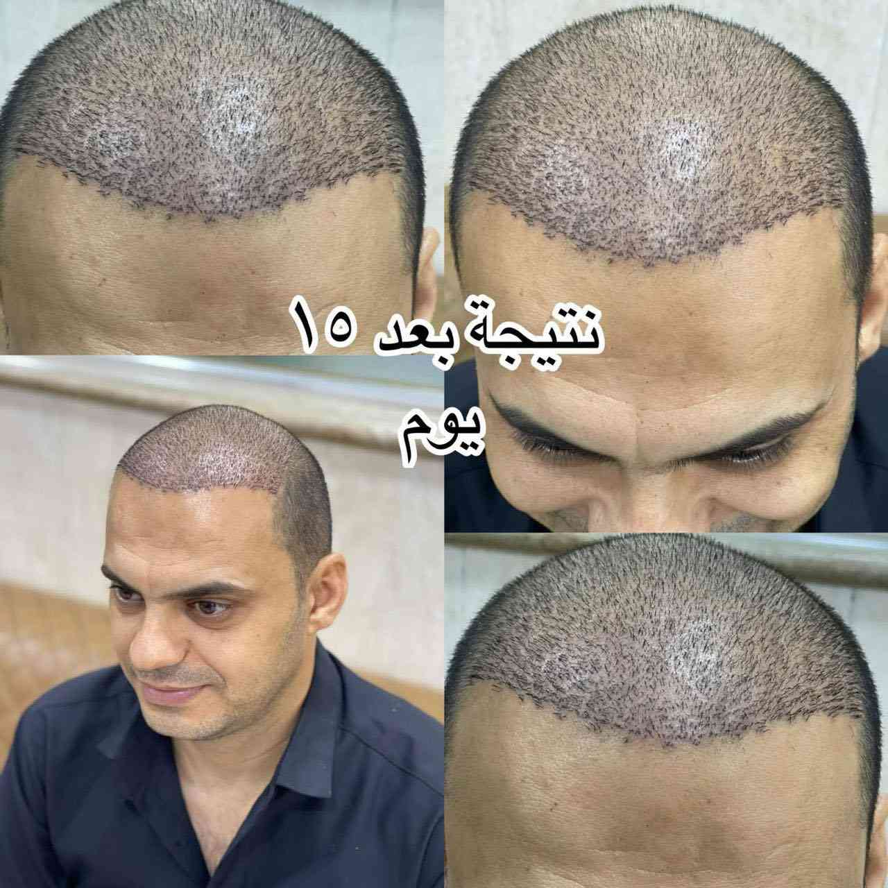 ملاحظة مهمّة جدًا 👇
قبل لا ينسرق الكلام من قبل المراكز
ويبدون يحچون بنفس الطريقة ونفس الصيغة

مركز المتخصص
هو المركز الوحيد
اللي يشرح كافة التفاصيل
قبل الزراعة وبعد الزراعة 🫵🔥👌

انتبه زين
قبل لا تتخذ القرار النهائي 👇

⸻

خطة زراعة الشعر مضمونة
على يد الطبيب المختص
شغل دقيق
يقلّل نسبة الخطأ إلى أدنى حد

المركز يتحمّل مسؤولية أي خطأ
أمّا نجاح العملية
فيعتمد على خبرة المختص
الذي يقوم بقطف البصيلات
بدقّة عالية جدًا

كما تعتمد النتيجة على
غرز البصيلات في المكان الصحيح
بعد فتح القنوات
بزاوية واتجاه صحيحين
وبما يتوافق مع اتجاه الشعر القديم

وتعتمد مرونة ومظهر الشعر
على عمق فتح القنوات
وبقياسات هندسية دقيقة
مدروسة بعناية
من قبل المختص

⸻

VIP اختيارك المفضّل

📞 واتساب للحجز:
***********

📞 الإدارة (واتساب):
***********

📞 واتساب للحجز:
***********
