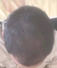 علاج شعر • تساقط شعر • شعر خفيف