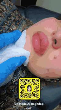 عرض لمدة يومين فقط سعر سيسي  50 الف ع ضمان الماده 
للحجز ***********
