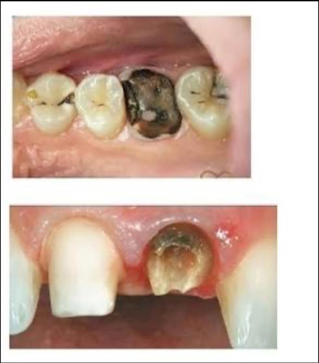 السلام عليكم طالبة طب اسنان مرحلة رابعة الاسبوع القادم نبلش شغل بعيادات اللي محتاج :
١_قلع الاسنان التالفة وبقايا الجذور 
٢_تنظيف الأسنان وازالة التكلسات والتصبغات
العلاج مجاني فقط حساب الوصل 
يتم العلاج تحت إشراف اطباء أختصاص ✅

العنوان/ الرمادي / جامعة المعارف 

للتواصل واتساب ***********
