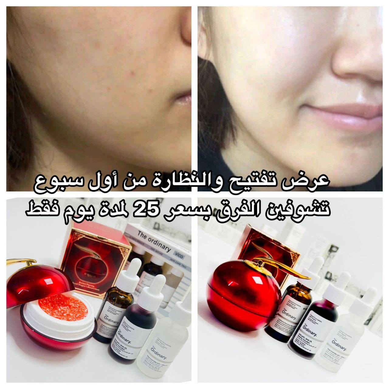 كريم التنين الكوري و سيرومات The Ordinary الثلاثية 🇨🇦 هدية من اختيارج 🎁 توصيل مجاني وبـسعر 25 ألف بدل 40❌
• يفتح البشرة ويقلل تصبغات 
• يقلل المسام والهالات 
• يمنح لمعة ونظارة صحية للبشرة
⏳ العرض لمدة 24 ساعة فقط
إذا تحبين اثبتلج الأوردر؟🫰🏻💗
من اول اسبوع حتبين النتائج 🤭
للحجز مراسله الصفحه❤


**إذا كنت صاحب هذا الإعلان وتريد حذفه لأي سبب، رجاءا أرسل رسالة إلى الدعم الفني**