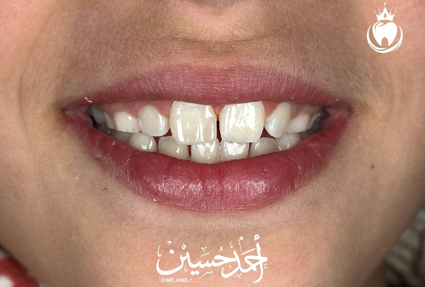 زارتنا طفلة مكسور سنها بسبب الوقوع🤕
 و هذا النوع من الحالات شائع بين  الاطفال في هذا العمر 
رجعنا السن لطبيعته بالحشوات و رجعنا ابتسامتها الحلوة بافضل المواد 
الشرح اسفل الصور 
المجمع الطبي الحديث مجاور مرطبات كرزة 
اوقات التواجد من ٣:٣٠ الى ٥:٣٠ قبل الافطار و كذلك بعد التراويح من ساعة ٩ الى ١٠:٣٠
للحجز و الاستفسار : ***********
