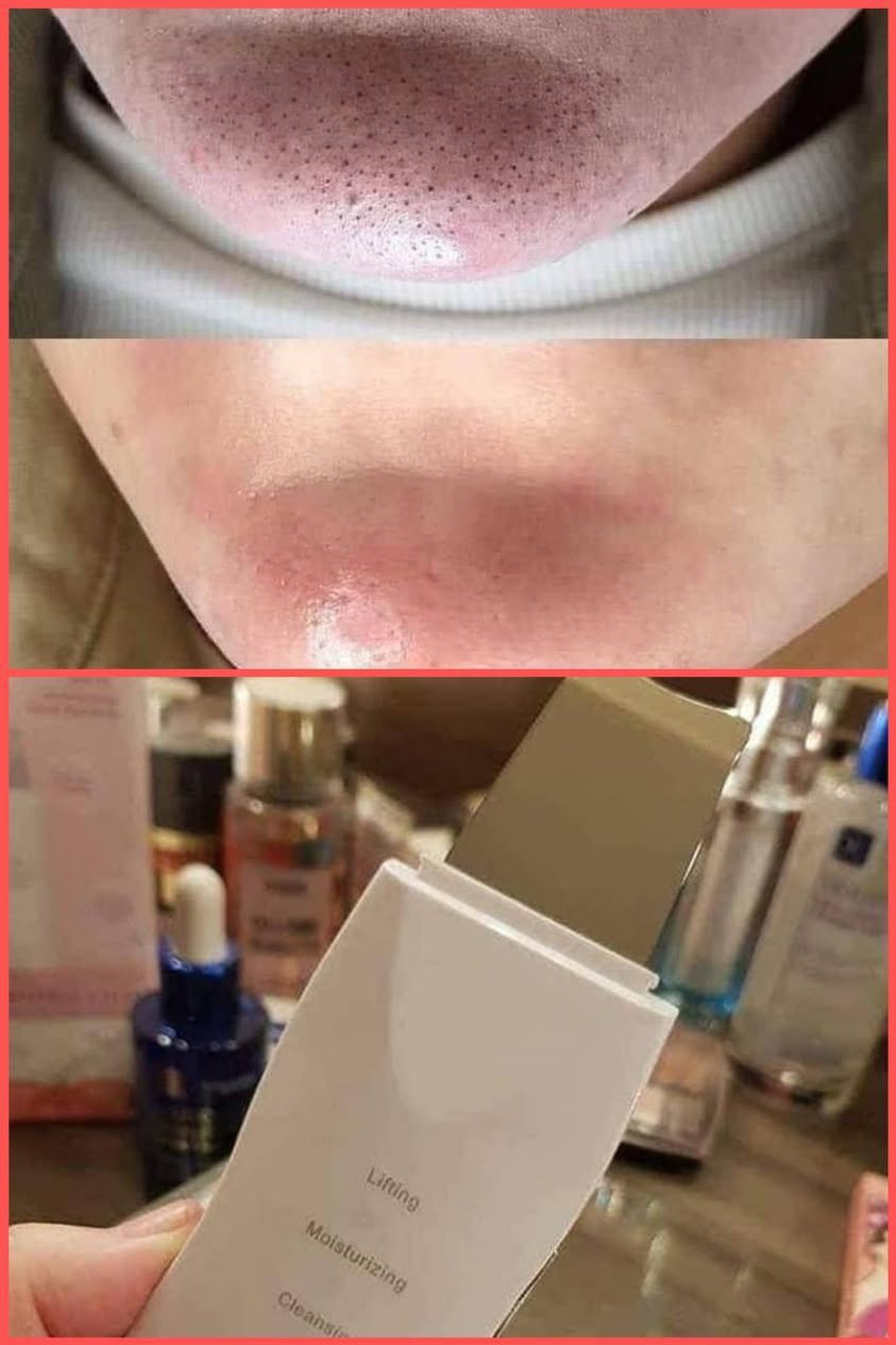 للحجز *********** أو خاص 
جهاز التقشير العميق للبشره جهاز التراسونيك سكن سكرابر Ultrasonic Skin Scrubber لتقشير البشرة العميق بالموجات فوق الصوتية ...
---------جهاز تقشير البشرة 
يعمل على ازالة الجلد الميت وعلاج التجاعيد والدهون والحبوب والحفر والبثور والترهلات وحب الشباب واثار حب الشباب كذلك تفتيح - تبييض - تحفيز افراز الكولاجين - تقشير سطحي بالالتراسونيك - تفتيت دهون البشرة يشد البشرة ويعيد لها نضارتها بالالتراسونيك - وعلاج الهالات السوداء - تجديد خلايا البشرة وشد البشرة
جهاز تنظيف وتقشير البشره #التراسونك 
شي عجيب شغله هذا الجهاز يزيل الرؤوس السوده ويقشر البشره بكل سهوله

Ultrasonc shovel
لتنظيف البشره العميق بتقنيه الموجات فوق الصوتيه
يعمل على تقشير وتنظيف الوجه بالموجات الفوق صوتيه (موجات التراسونيك عاليه التردد اي بذبذبات تلك الموجات يتم التنظيف العميق لها
يقوم بتنظيف عميق لبشره وجهك وازاله الزيوت منها (جيد للبشره الدهنيه ) وبالتالي ازاله الجلد الميت
وتحفيز لخلايا البشره وتخليصها من السموم والشوائب الضاره والعالقه بها
وكذالك تحفيز الكولاجين المسؤؤل عن نضاره البشره وشد البشرة

وقبل الاستخدام نقوم بتنضيف بشرتك من اي مكياج عالق به وابدئي بالتتقشير

السعر 13 الف عرض خاص
