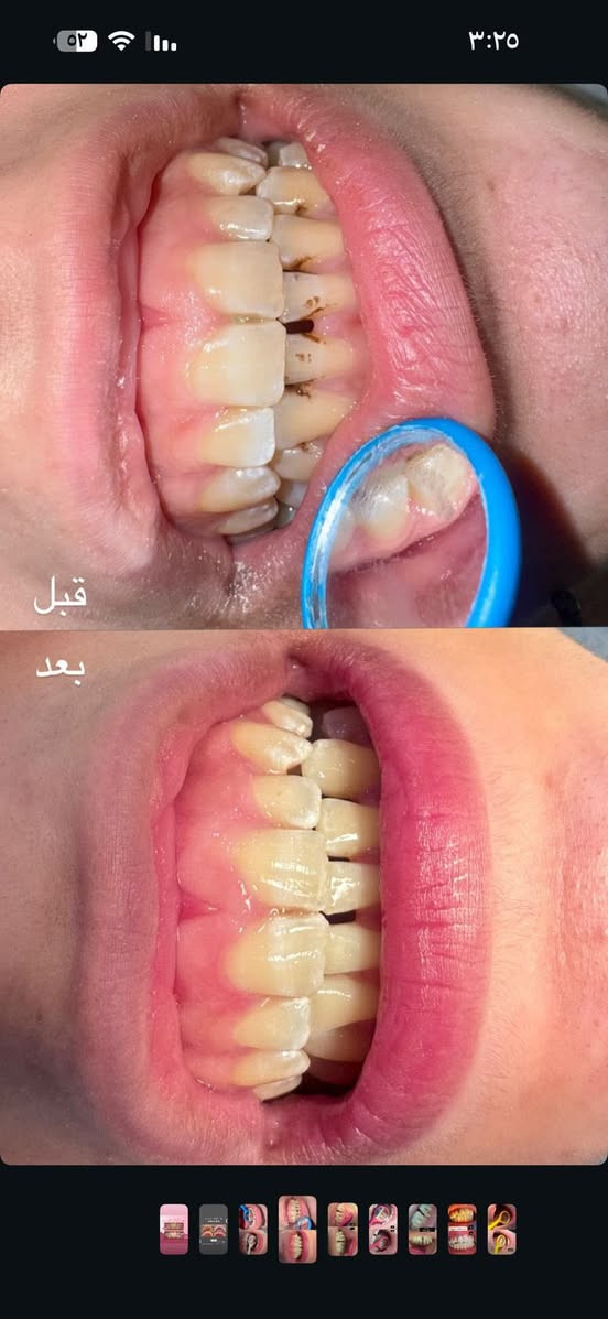 ⚠️اي شخص محتاج تنظيف وتبييض للأسنان تواصل معي على الرقم 
/واتساب***********

📍الموقع: عيادات جامعة اهل البيت /الحر الصغير /قرب مدينة العاب النوارس
