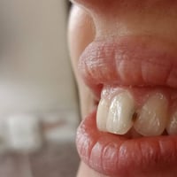 قلع بدون ألم • تنظيف أسنان • الحر عيادات أهل البيت