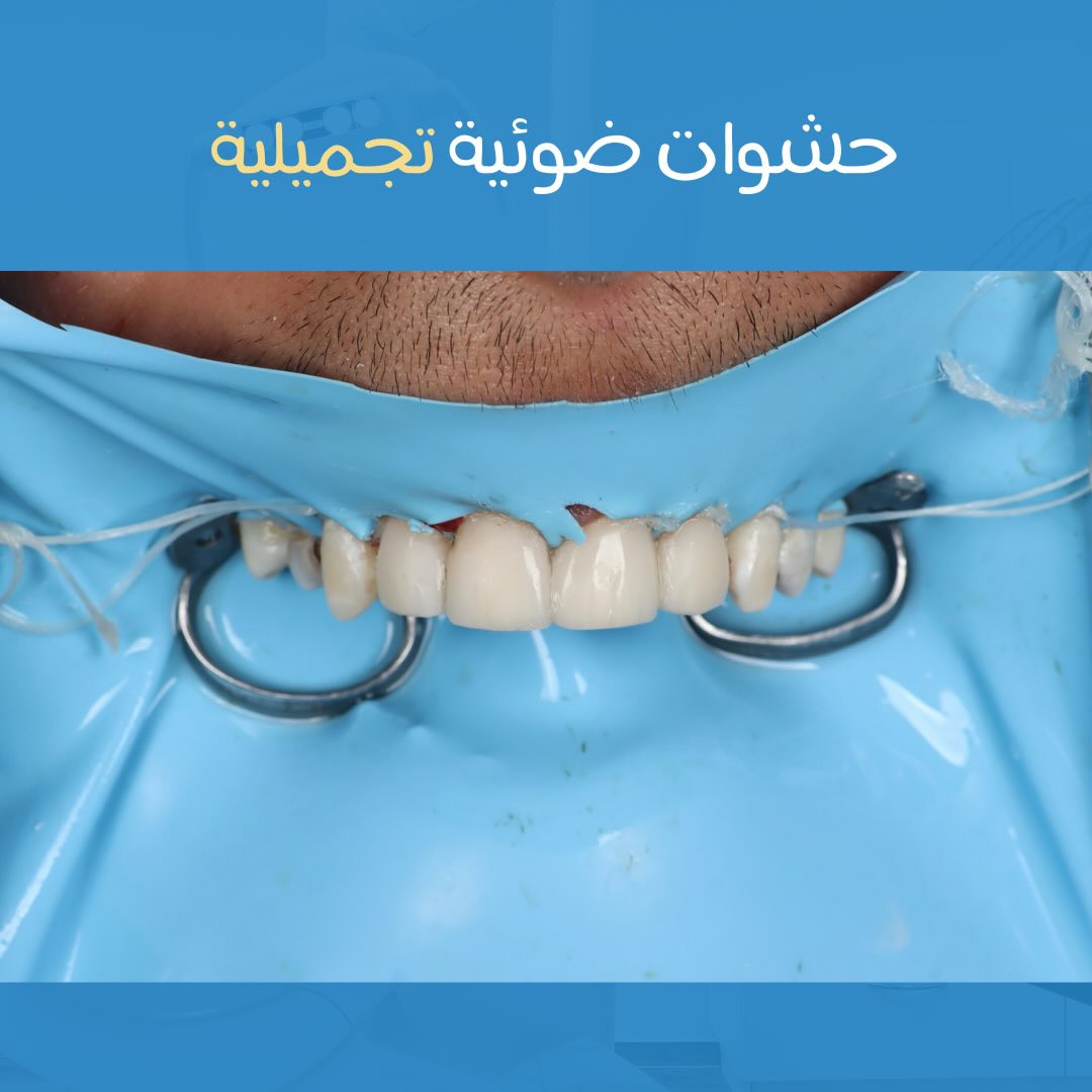 ✨ حشوات تجميلية للأسنان الأمامية ✨

تم إجراء حشوات تجميلية للأسنان الأربعة الأمامية
بدقة عالية ومواد متطورة
لإعادة الشكل الطبيعي واللون المتناسق
والحصول على ابتسامة ناعمة وقريبة من الأسنان الأصلية 🦷🤍

النتيجة:
تحسين فوري بالشكل، وثقة أكبر بالابتسامة ✨

📍 السماوة – الإسكان – مقابل كافتيريا كناري
📞 ***********
⏰ الدوام من 3 عصراً إلى 10 مساءً – طوال أيام الأسبوع
