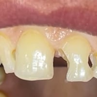 عيادة الطائي لطب الاسنان ♥️  حشوات تجميلية بأجمل صورة باستخدام مواد رص...