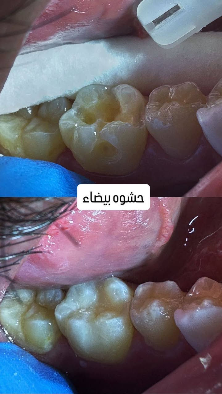 إذا تبحث عن العناية بأسنانك بأيدي خبير، زور عيادة الدكتور هاشم غسان.
✅ فحص وتشخيص دقيق

✅ علاج وحشوات الأسنان

✅ تنظيف وتلميع الأسنان

✅ سحب الأسنان

✅ تركيبات وتجميل الأسنان

نهتم براحتكم ونحرص على تقديم أفضل رعاية بابتسامة وثقة.

📍 العنوان: موجاور دكتوره حنين نجم جبوري)

📞 للحجز والاستفسار: (***********)

الدكتور هاشم غسان – لأن ابتسامتك تستحق الأفضل.

