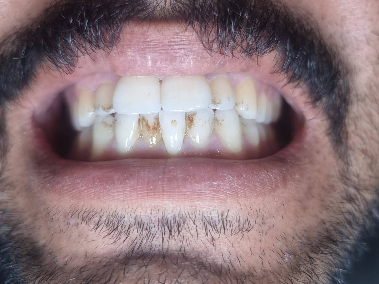 من الاعمال اليوميه لعيادتنا
#عيادة_كوثى_لطب_وتجميل_الاسنان 

تنظيف الاسنان لاحد مراجعينا💫
التخلص من التصبغات الجيريه على طبقة المينا
ومنضر الاسنان 
ليتحول  منظر الاسنان الى لامع ناصع البياض
#الدكتور_علي_حسن_العزاوي

يتوفر العمل بالتقسيط المريح على زراعة وتغليف الاسنان

بابل/جبله/نهاية شارع الاطباء (مقابل مجمع الدكتوره ميثاق المعموري )
للاستفسار
***********
