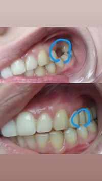 جامعة بلاد الرافدين تقاطع القدس • طقم جزئي متحرك • مجانا