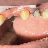 عيادة الطائي • تغليفات زاركون • سبع البور