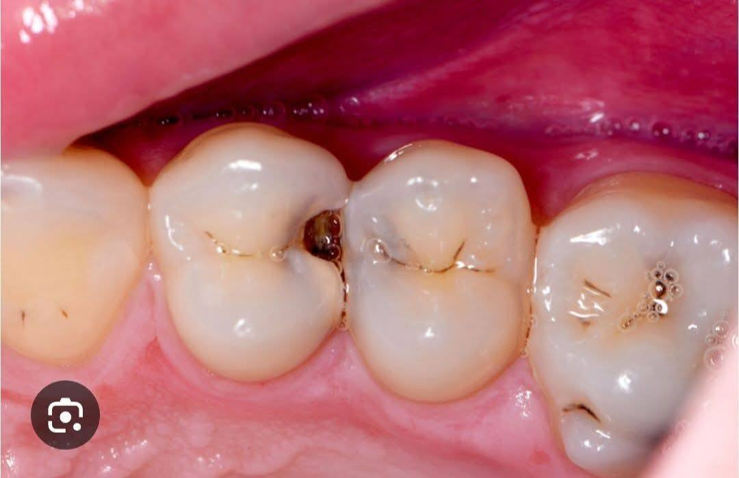 السلام عليكم
يتوفر :
حشوات ضوئيه تجميلية✅

قلع الاسنان و الجذور التالفه✅

تعويض الاسنان بطقم جزئي متحرك✅

مجانا و لفترة محدوده🔥

📍مدينة الامام الحسين الطبيه /مدخل المدينه القديمه /عيادات طب الاسنان

💬✅للتواصل عبر الواتساب/***********
