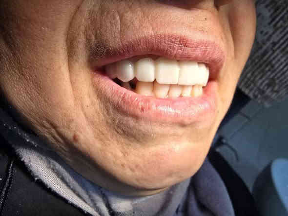 😁اليوم الحاله هي تغيير جذري لابتسامة مراجعتنا😁

💎تم عمل تركيب و تغليف زاركون درجة اولى اصلي لمراجعه تعاني من فقدان اسنان اماميه و ايضا كسر في الاسنان الاخرى 

💢تم برد الاسنان الاماميه بقياسات علمية دقيقة 
💢تم عمل الحشوات بواسطة العازل المطاطي قبل تحضير الاسنان 
💢اخذ طبعة بواسطة الصورة الرقميه للاسنان و تمتاز هذه المادة بدقة عالية لاخذ قالب الاسنان 
💢ارسال الطبعة الى مختبر ذو ايدي خبيرة و ماهرة في عملها 
💢ثم تركيب اسنان الزاركون للمراجع

✨كل هذا العمل بجلستين فقط !!
✨و النتيجه مثل ما تشوفون 
✨احلى شعور من تشوف المراجع فرحان بابتسامته من جديد

✨ابتسامتكم ويانه احلى✨
عيادة البدر لطب وزراعة وتقويم الاسنان 
للحجز والاستفسار:
***********
