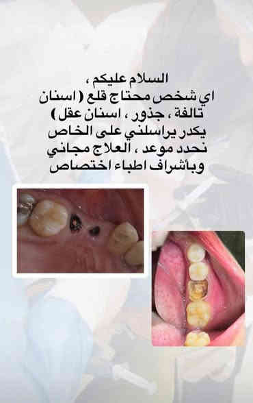 العلاج #مجاني لفترة محدودة
تعلن عيادات طب الاسنان في جامعة الكوفة عن استقبال المراجعين الذين يعانون من :
1- تكلسات وتصبغات الأسنان (تنظيف الأسنان) 
2-قلع الاسنان التالفة وبقايا الجذور
3- ازالة جميع التسوسات وعمل حشوات تجميلة
4- تعويض الأسنان المفقودة بطقم جزئي متحرك
للأستفسار اكثر مراسلة صفحتنا 
او عن طريق الواتساب ***********

#صحة #اسنان #مجاني #اهتمام #رخيص

