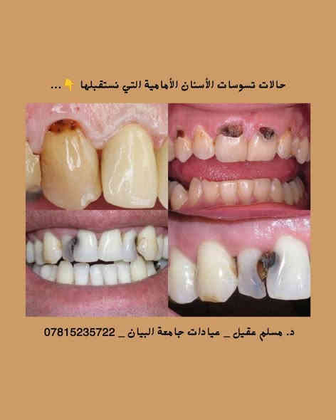 🔹️يسعدني استقبالكم في عيادات كلية طب الأسنان _ جامعة البيان _ شارع مطار بغداد الدولي – قرب ساحة عباس بن فرناس ...

🔹️العلاج بإشراف أساتذة مختصين وبعلاج مجاني بالكامل 💙🦷...

🔹️أسنانكم أمانة... وابتسامتكم مسؤوليتنا 💫
نقدّم رعاية شاملة لجميع الحالات، مع متابعة دقيقة لضمان أفضل النتائج...

🔹️الحالات التي نستقبلها :
• تنظيف وإزالة التكلسات والتصبغات.
• فحص شامل للأسنان وتقييم اللثة.
• إزالة التسوسات وحشوات ضوئية وبلاتينية.
• قلع الأسنان الأمامية والخلفية والجذور التالفة.
• عمل أطقم جزئية متحركة لتعويض الأسنان المفقودة.
• متابعة دورية للحالات لضمان استقرار النتائج.

🔹️للحجز والاستفسار 📩:
• واتساب: ***********
• إنستغرام: dent.muslim1
• تلغرام: @Dr_Muslim45

#العراق #بغداد #عيادات_جامعة_البيان #ابتسامتك_مسؤوليتنا #تنظيف_أسنان #حشوات_ضوئية #ابتسامة_صحية #مجاني #Baghdad #Iraq #طب_الأسنان #DentalCare #Smile #TeethCleaning #عيادات_مجانية #اكسبلورر #لايك
