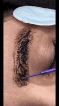 جلسة ازالة تاتو بغداد الشعب حي البساتين ***********
